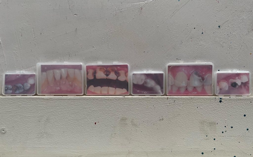 IMG 5521 Rotte tanden Insta